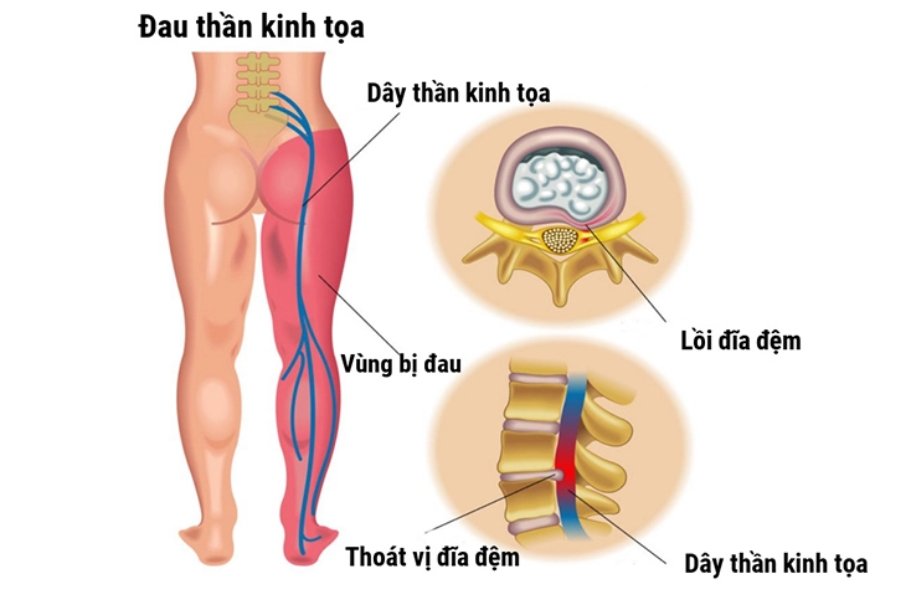 Bệnh đau thần kinh toạ