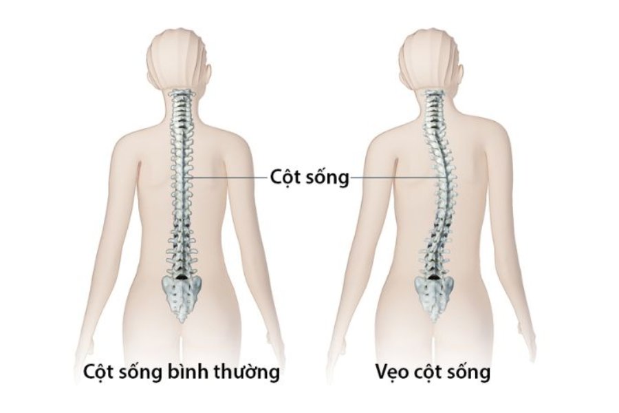 Bệnh vẹo cột sống