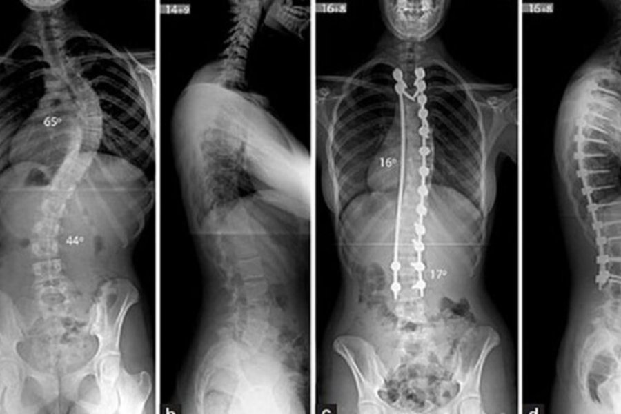 Chẩn đoán và phát hiện bệnh cột sống thế nào?