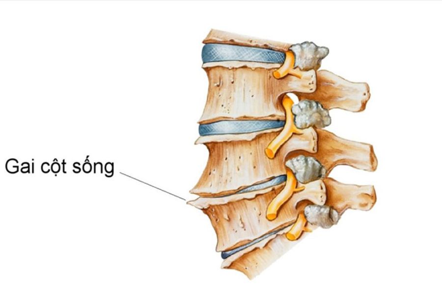 Có nhiều nguyên nhân gây ra bệnh gai cột sống lưng