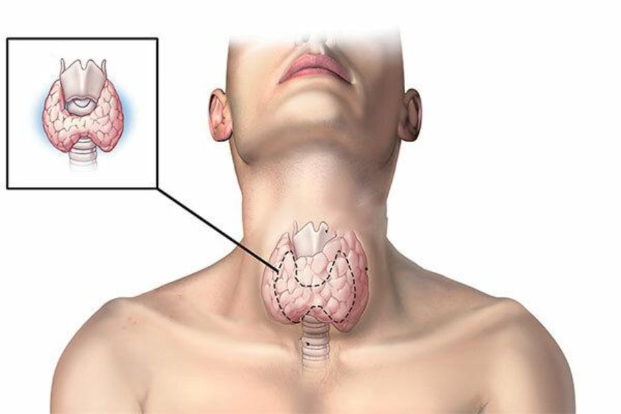 Không thể điều trị hoàn toàn bệnh ung thư tuyến giáp giai đoạn cuối