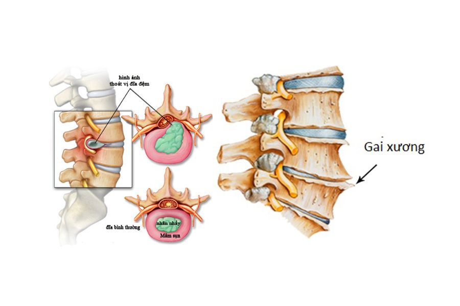 Gai cột sống bẩm sinh còn được gọi là gai cột sống S1