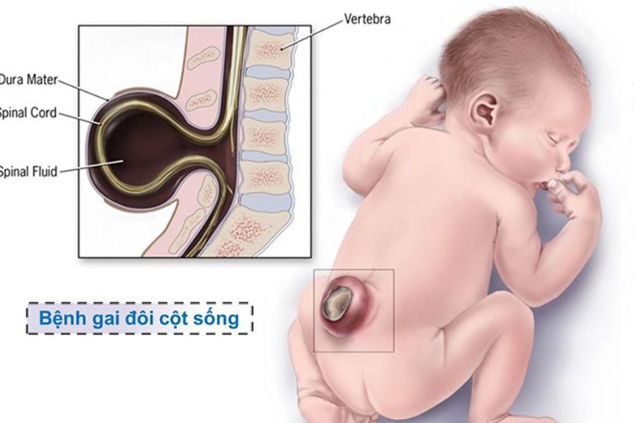 Trẻ bị dị tật nứt đốt sống bẩm sinh có thể xảy ra do nhiều nguyên nhân 