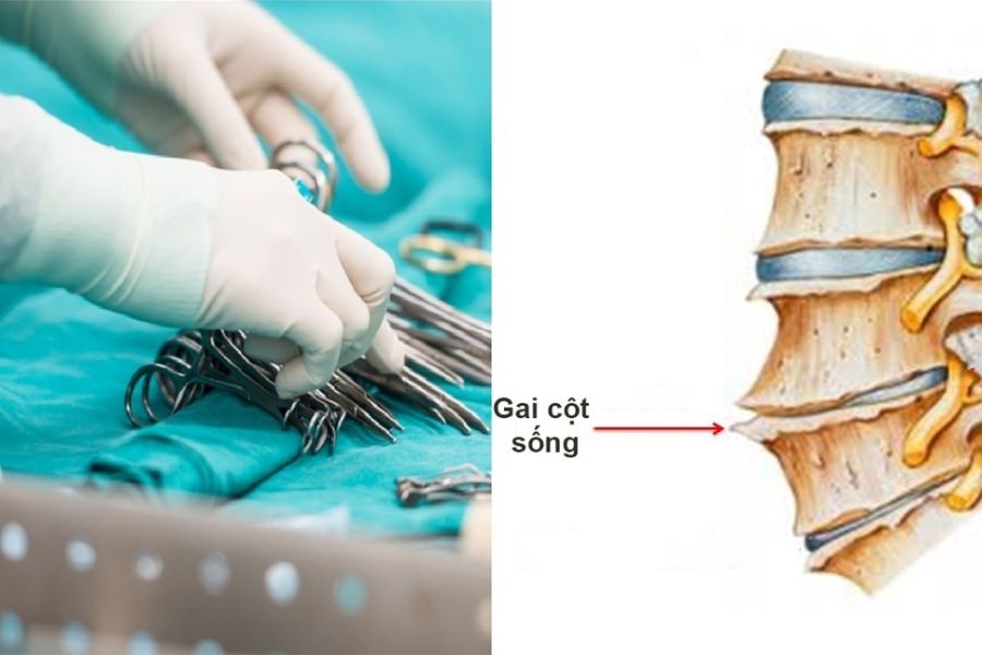 Phẫu thuật là phương pháp được dùng khi tình trạng gai đôi cột sống trở nặng 