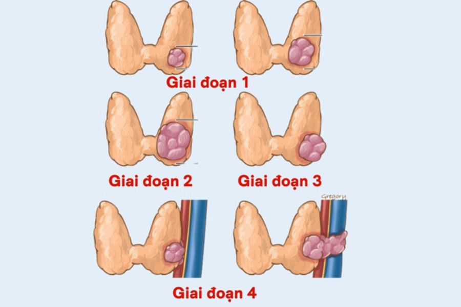 Các giai đoạn của ung thư tuyến giáp