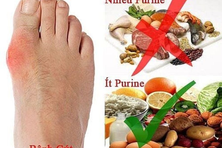 Người bệnh gout nên hạn chế các thực phẩm nhiều purine