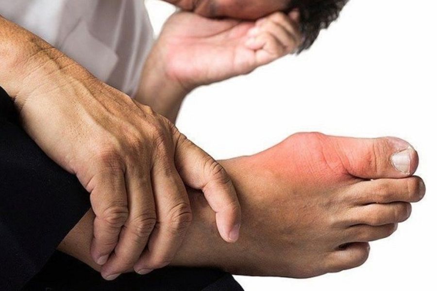 Mối liên quan của bệnh gout và tiểu đường