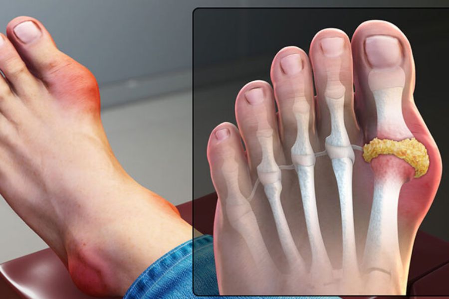 Gout hình thành do sự tích tụ quá mức của axit uric