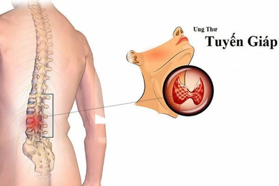 Ung thư tuyến giáp di căn là bệnh lý mà các tuyến giáp xảy ra tình trạng bất thường