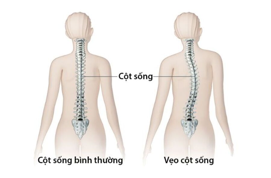 Vẹo cột sống nhẹ là tình trạng cột sống bị vẹo sang 1 bên tầm 10 - 25 độ