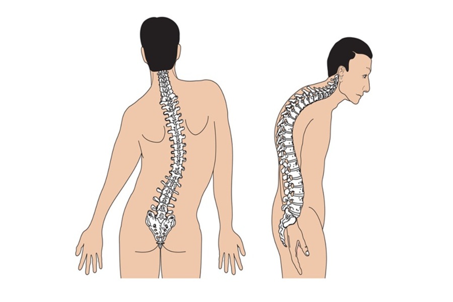 Vẹo cột sống nhẹ nếu không được điều trị sẽ dẫn đến các ảnh hưởng về cơ xương