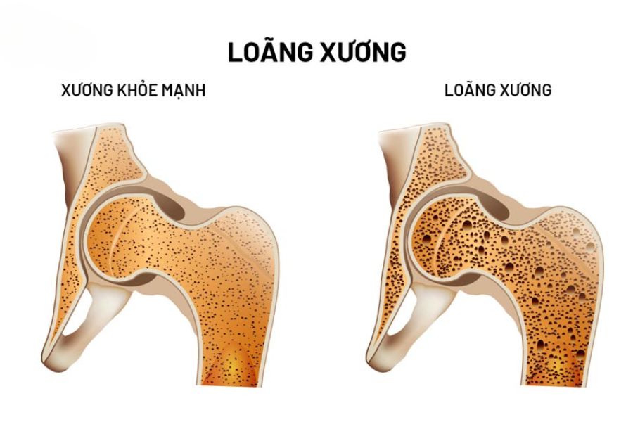 Loãng xương gãy cột sống, đốt sống lưng