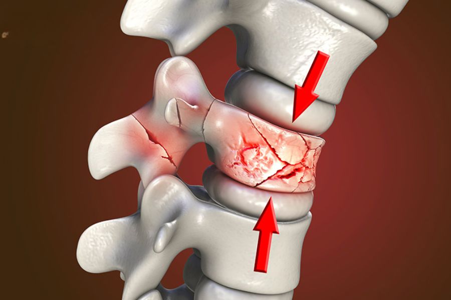 Gãy đốt sống lưng là gì?