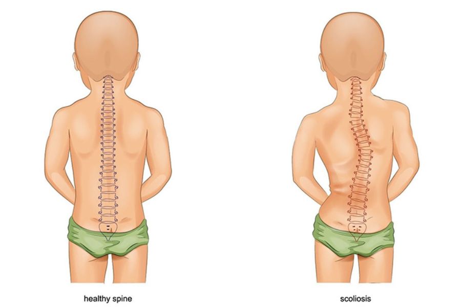 Nhiều người bị lệch cột sống có thể do bẩm sinh