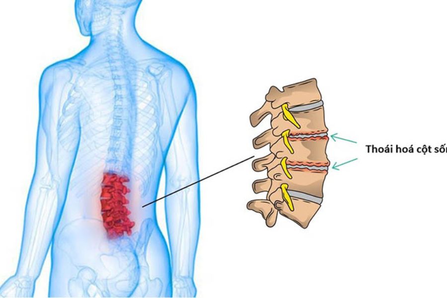 Thoái hóa cột sống là một dạng viêm khớp mãn tính