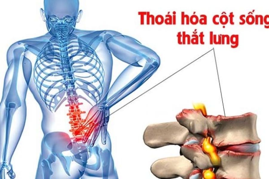 Thoái hóa cột sống thắt lưng có thể do chế độ dinh dưỡng, làm việc sai tư thế gây ra