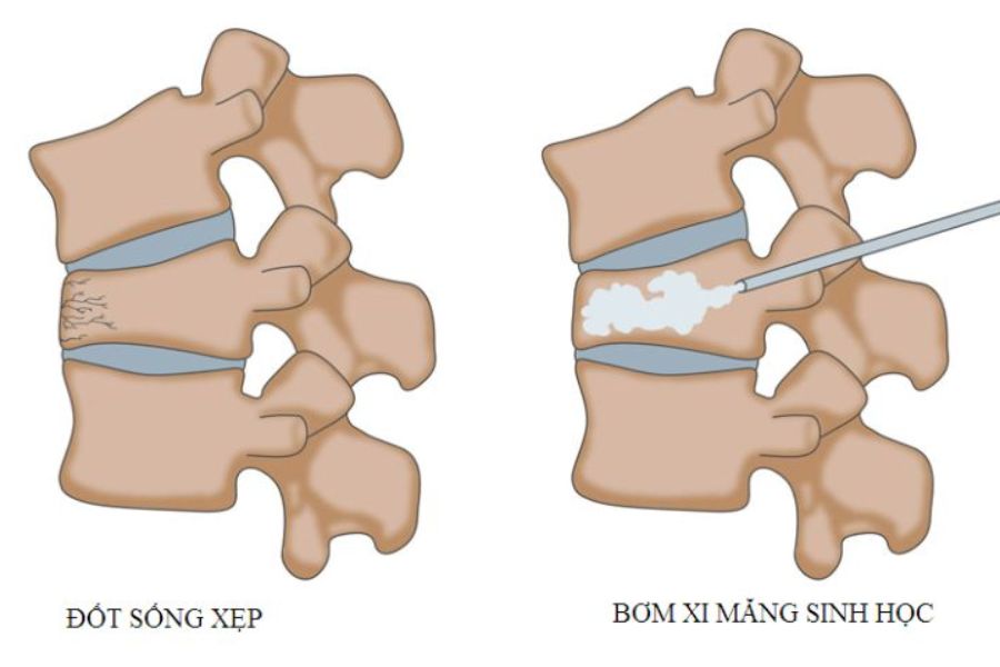 Bơm xi măng cột sống có nguy hiểm không? 3 Lưu ý 