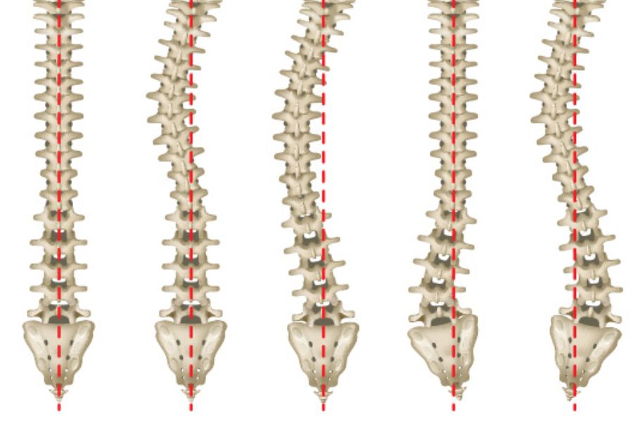 Các loại cong vẹo cột sống học đường