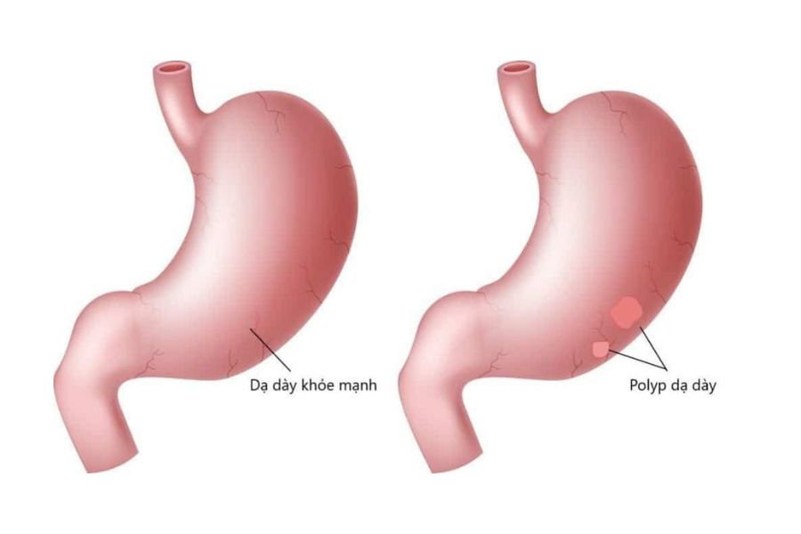 Sau khi cắt polyp dạ dày, người bệnh có thể gặp một số biến chứng khác nhau