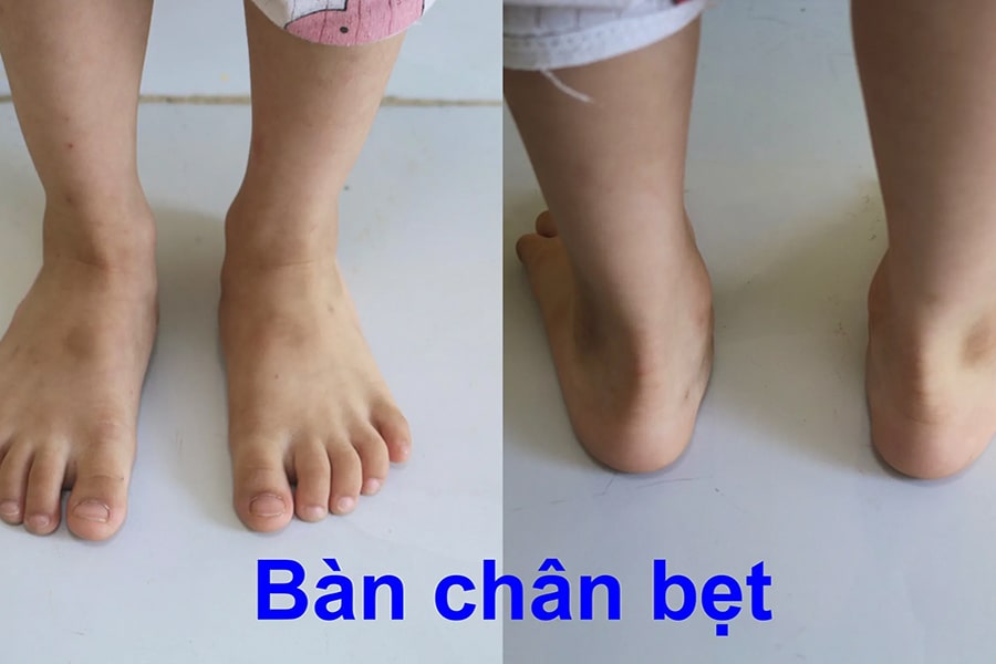 Rủi ro, tác dụng phụ của phẫu thuật bàn chân bẹt có thể gặp phải