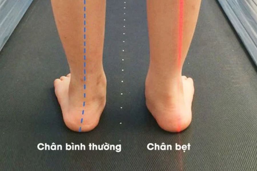 Bàn chân bẹt xảy ra khi vòm bàn chân tiếp xúc trực tiếp với mặt đất