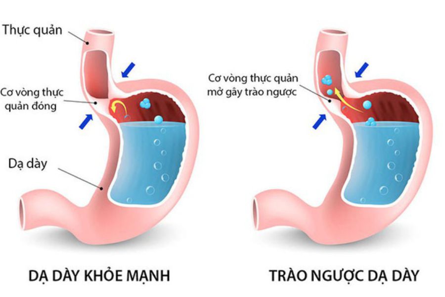 Dinh dưỡng đóng vai trò quan trọng với người mắc trào ngược dạ dày