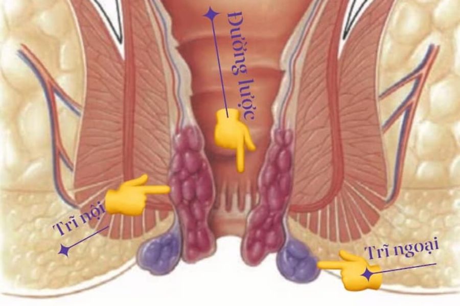 Phân loại bệnh trĩ