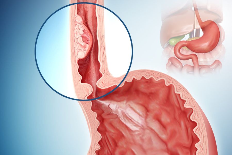 Trào ngược dạ dày độ D bệnh có thể tiến triển thành ung thư thực quản