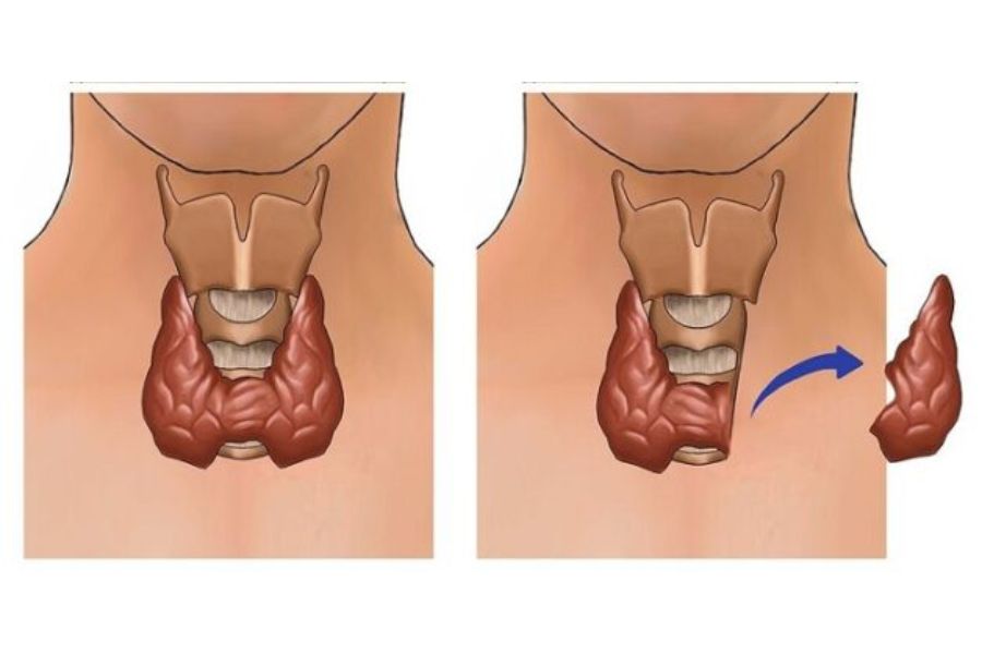 Phẫu thuật cắt bỏ một thùy tuyến giáp