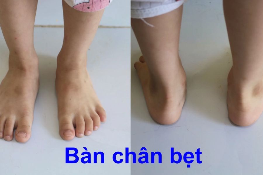 Nhận biết bàn chân bẹt qua nhiều dấu hiệu khác nhau