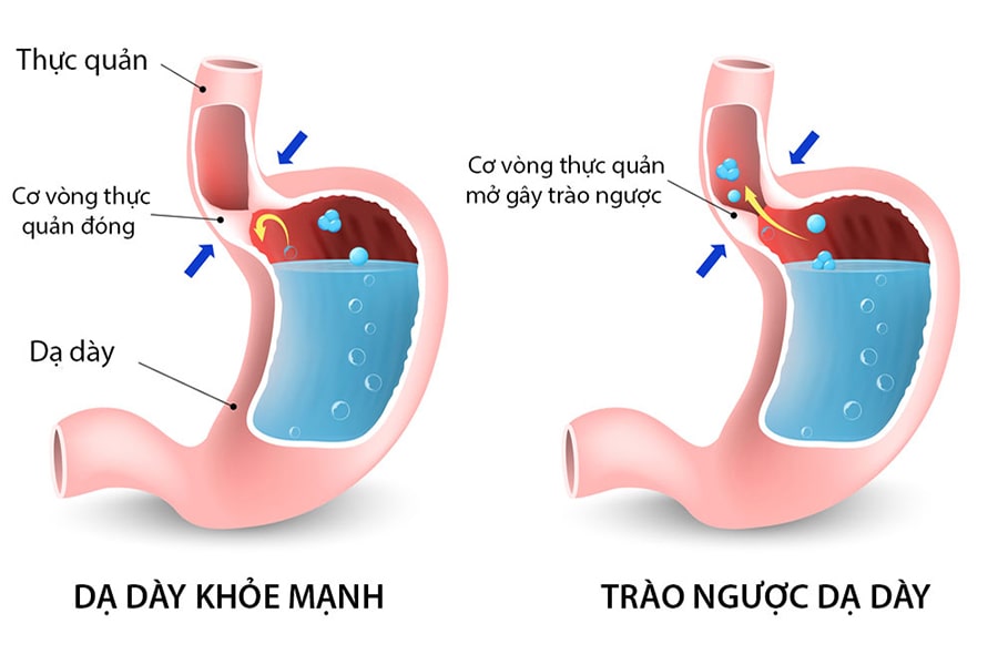 Minh hoạ cơ vòng khi bị trào ngược dạ dày