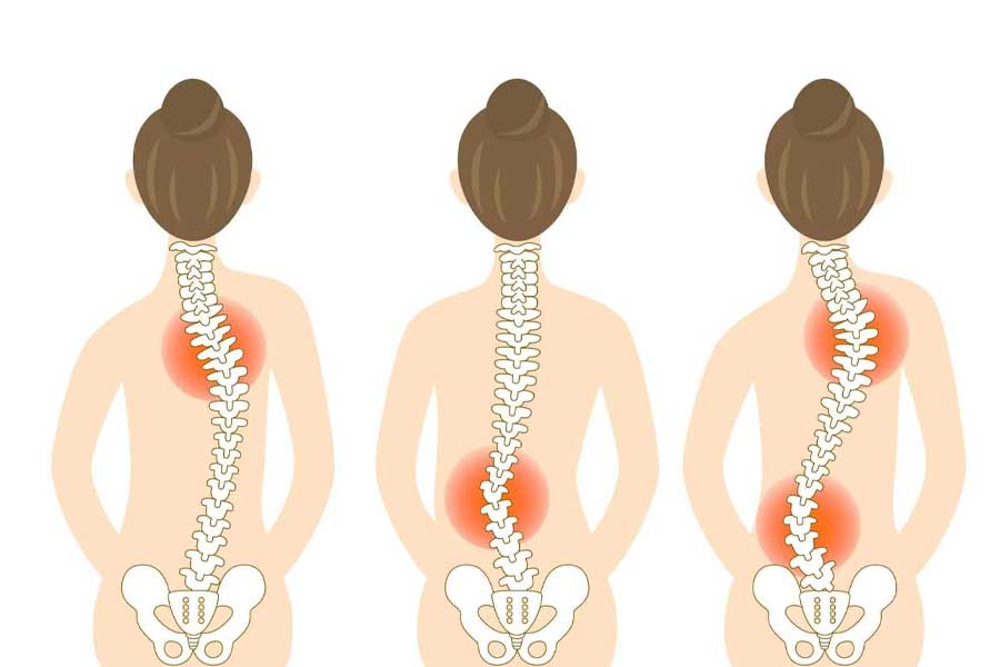 Cong vẹo cột sống là một dị tật lành tính và ít gây ra các triệu chứng nguy hiểm cho tính mạng