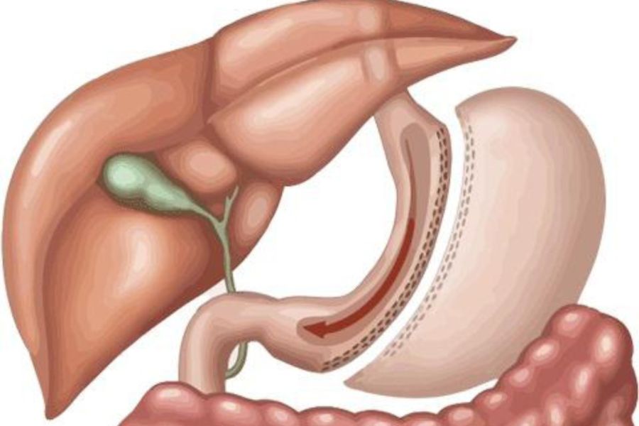 Phẫu thuật cắt dạ dày sống được bao lâu?