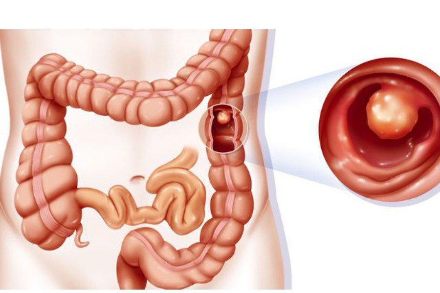 Polyp đại tràng không cuống có tiềm ẩn nguy hiểm không?