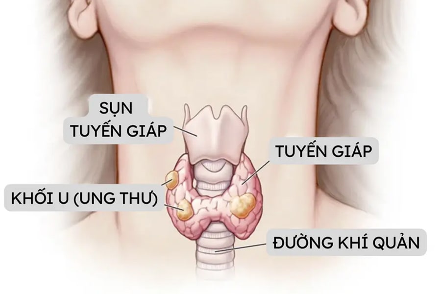 Mổ u tuyến giáp bao nhiêu tiền? Ở đâu tốt? 2025