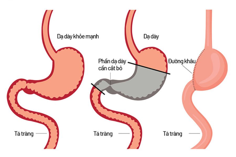 Cắt dạ dày bao nhiêu tiền? Ở đâu tốt 2025