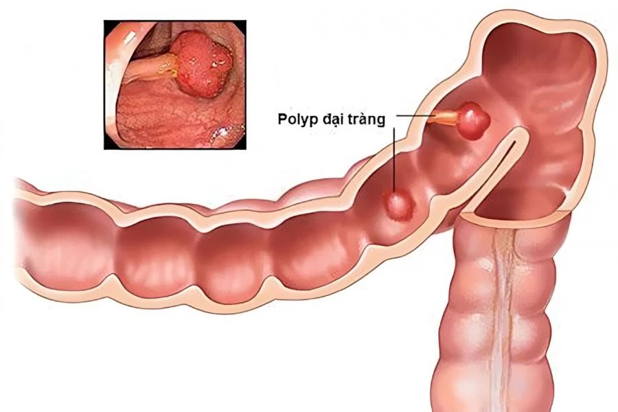 Bệnh Polyp đại tràng là khối tế bào nhỏ xuất hiện trên niêm mạc ruột già