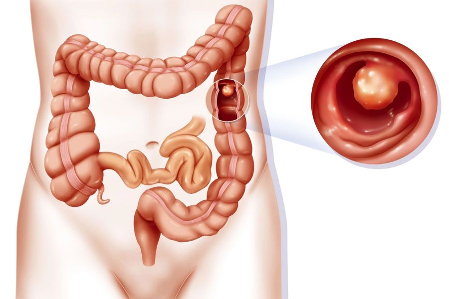 Polyp trực tràng có nguy hiểm không?