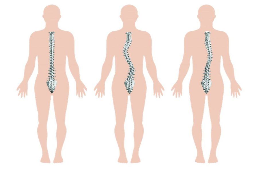 Cong vẹo cột sống làm ảnh hưởng đến dáng đi của mọi người