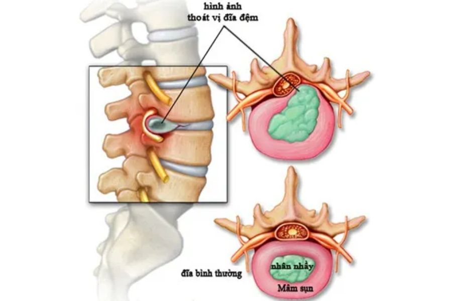 Thoát vị đĩa đệm vừa gây đau vừa gây khó khăn khi di chuyển