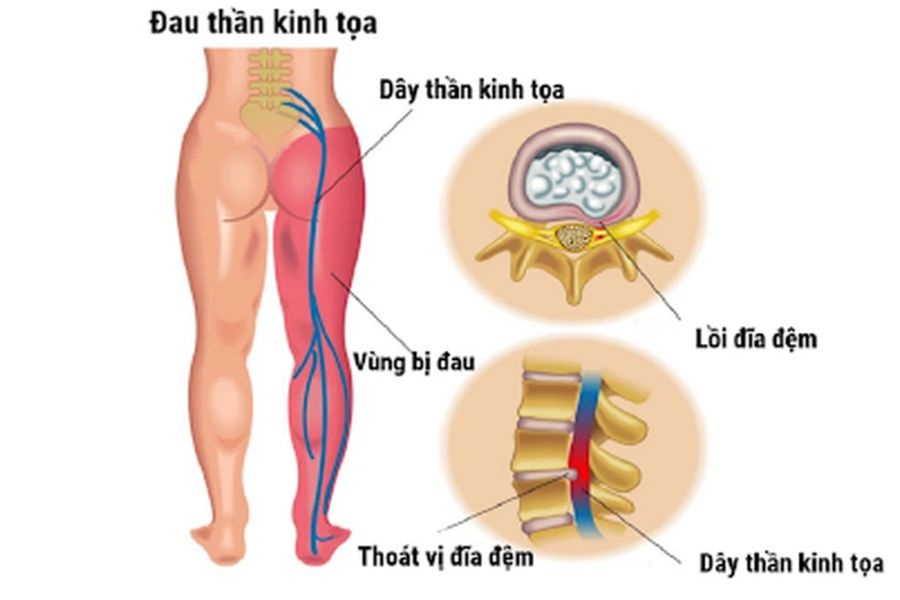 Đau thần kinh tọa là tình trạng bệnh lý, thường gặp biến đối với nhiều người