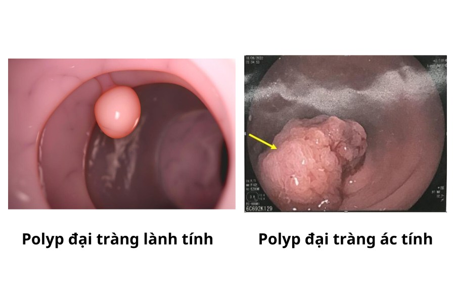 Phân biệt Polyp đại tràng lành tính và Polyp đại tràng ác tính