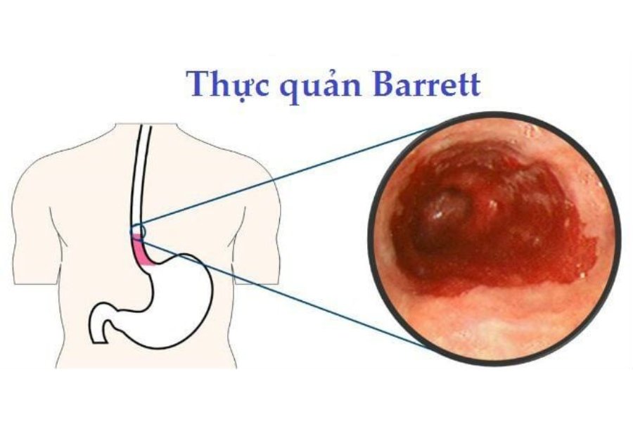 Trào ngược dạ dày gây cảm giác khó thở có thể dẫn đến Barrett thực quản