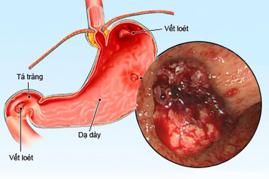 Viêm loét dạ dày nặng là giai đoạn khá nguy hiểm của bệnh 