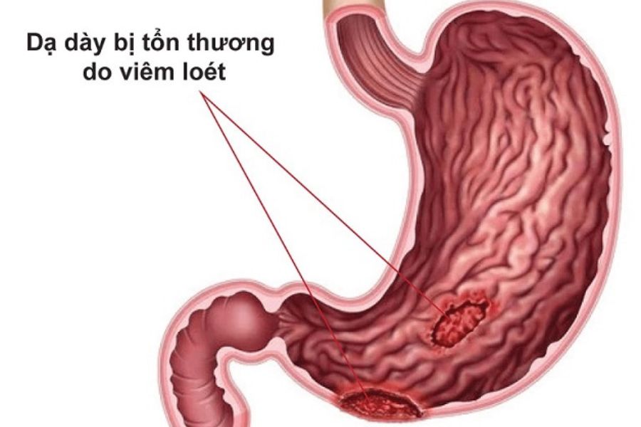 Dạ dày bị tổn thương có thể do nhiều nguyên nhân gây ra