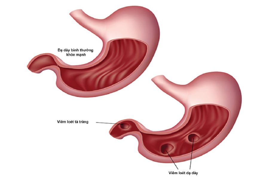 Có thể nhận biết tình trạng viêm loét dạ dày nặng qua nhiều dấu hiệu khác nhau