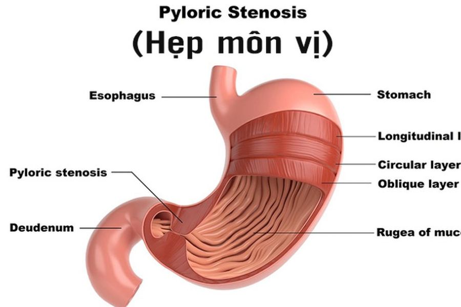 Hẹp môn vị dạ dày là biến chứng của viêm loét dạ dày nặng 