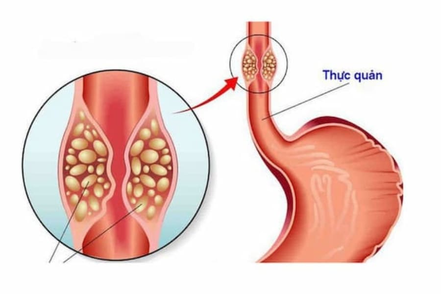 Viêm trào ngược dạ dày độ A xảy ra khi các triệu chứng bệnh đã xuất hiện một thời gian